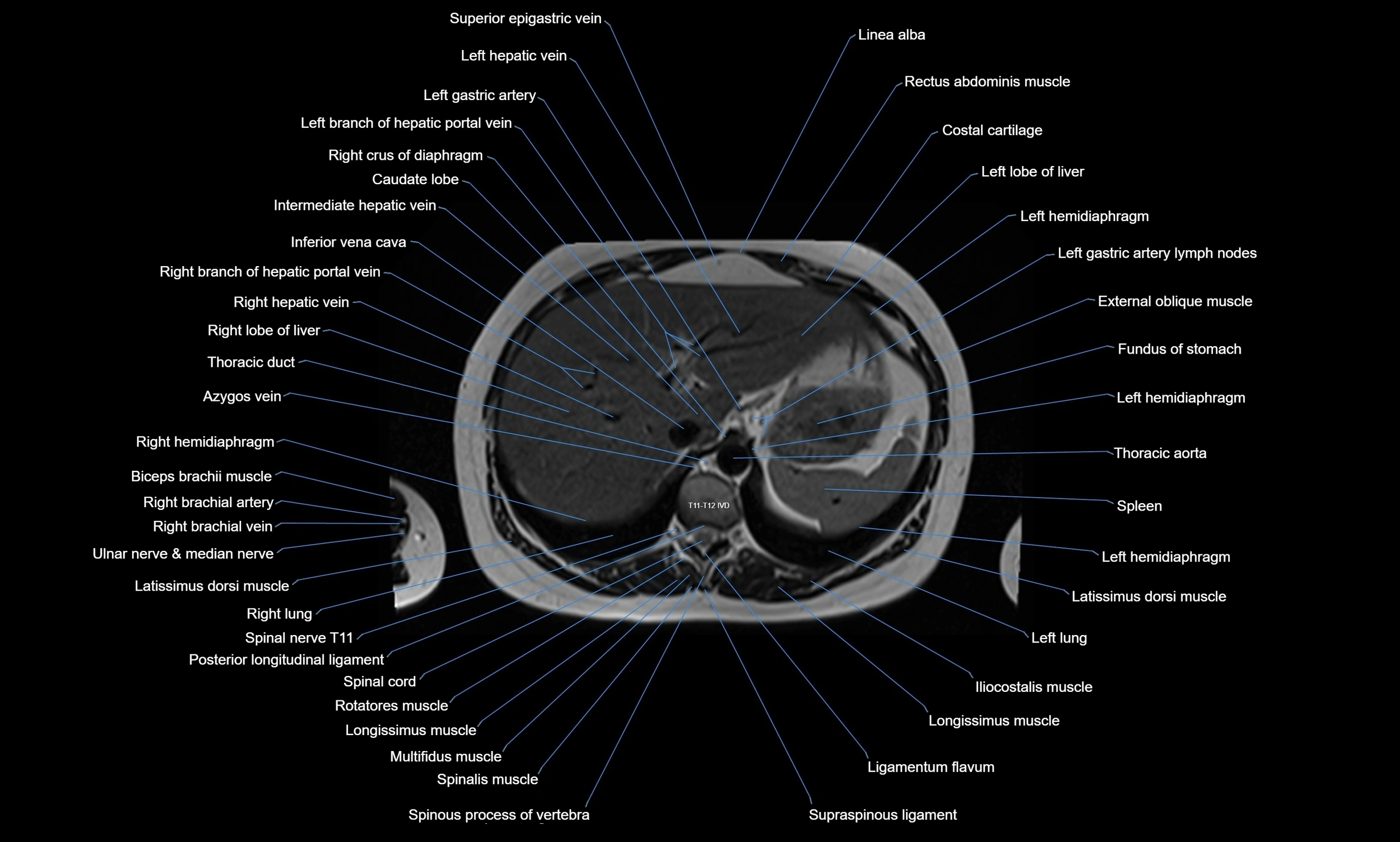 MRI chest axial  cross sectional anatomy 3T radiology  image-img-00001-00041.webp